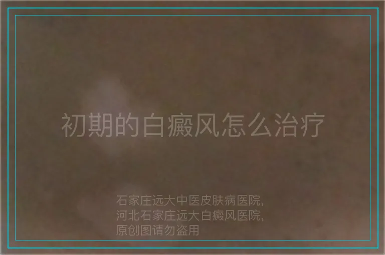 初期的白癜风怎么治疗
