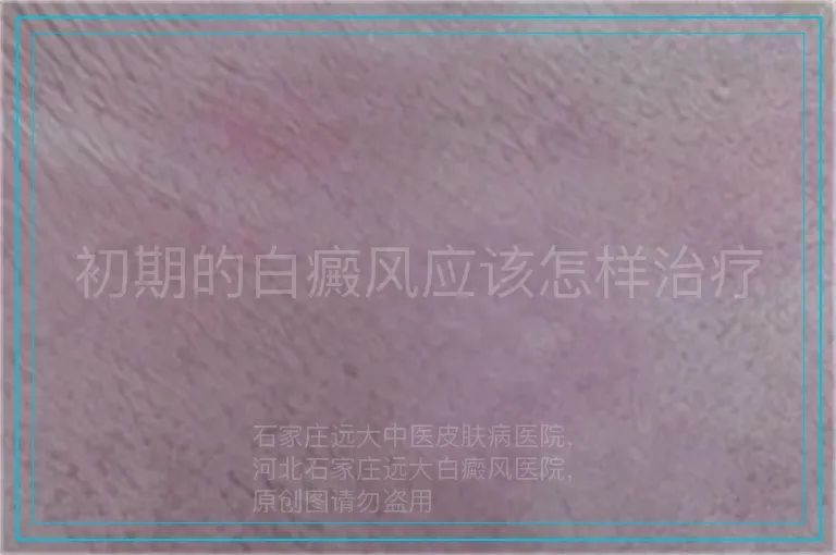 初期的白癜风应该怎样治疗