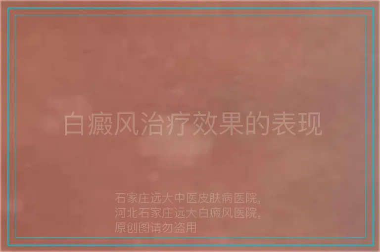白癜风治疗效果的表现