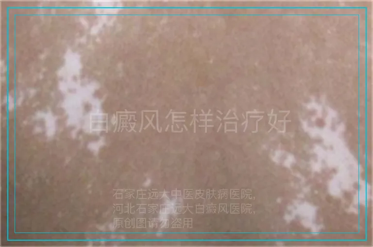 白癜风怎样治疗好