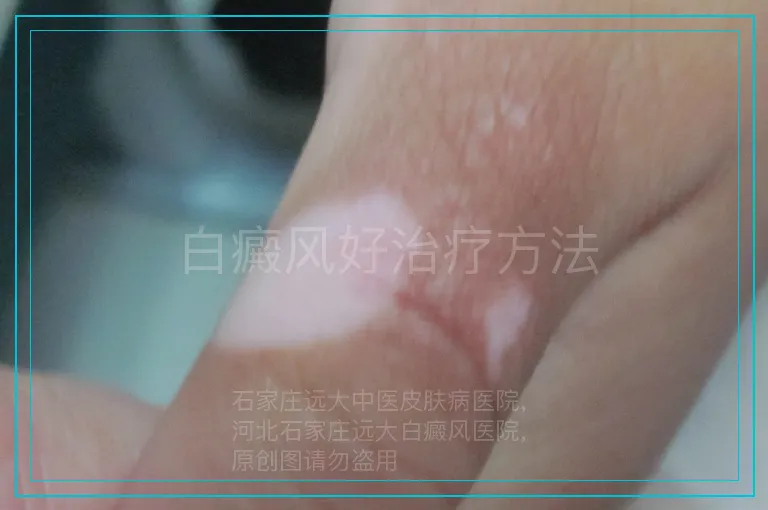 白癜风好治疗方法