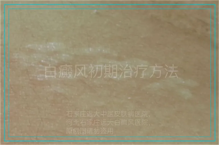 白癜风初期治疗方法