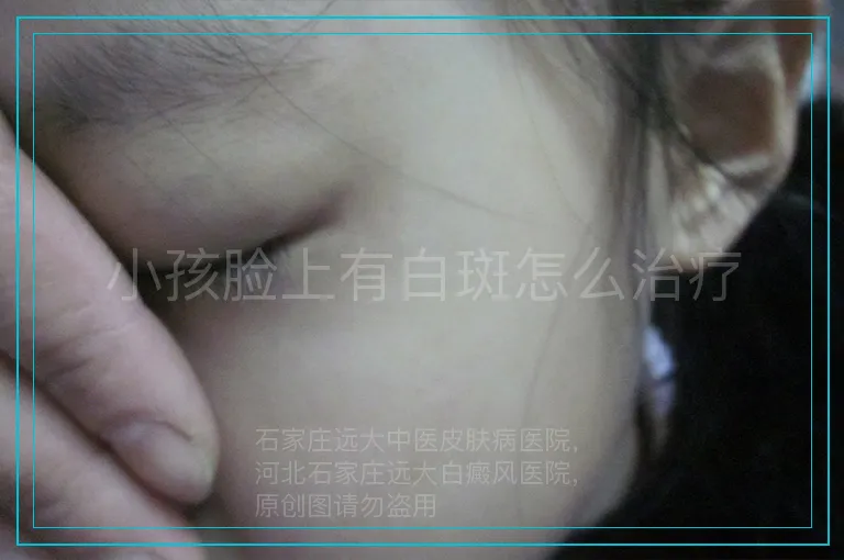 小孩脸上有白斑怎么治疗