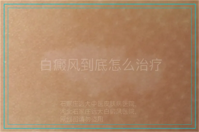 白癜风到底怎么治疗