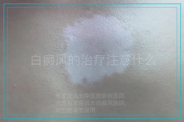 白癜风的治疗注意什么
