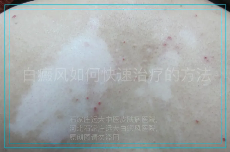 白癜风如何快速治疗的方法