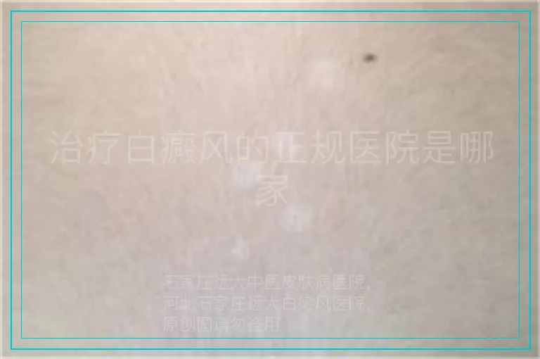 治疗白癜风的正规医院是哪家