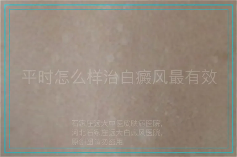平时怎么样治白癜风最有效