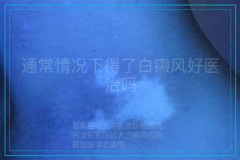 通常情况下得了白癜风好医治吗