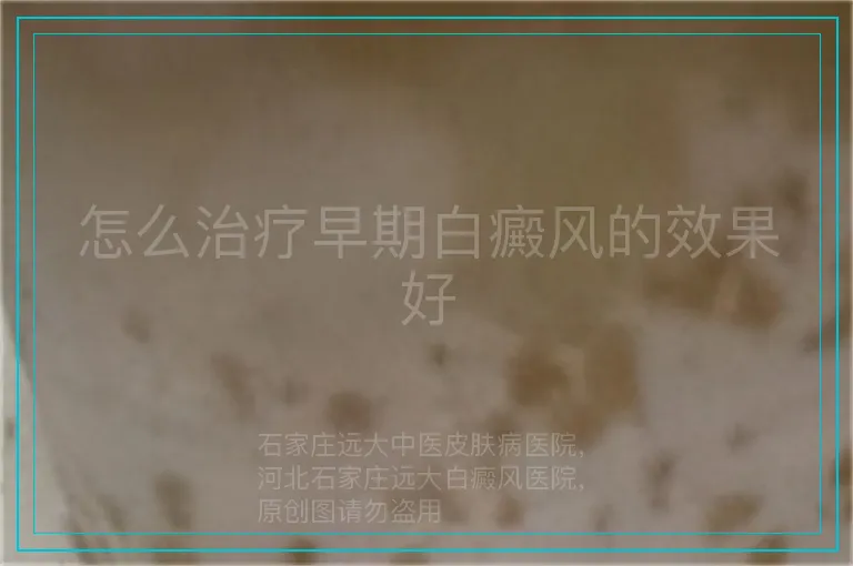怎么治疗早期白癜风的效果好