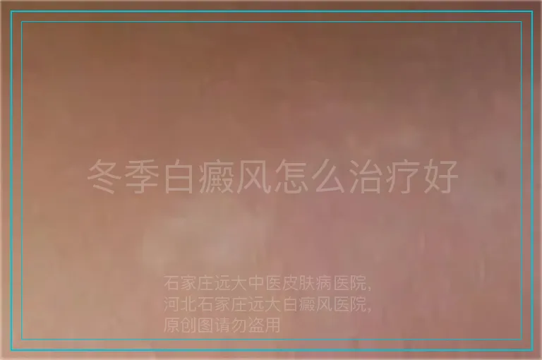 冬季白癜风怎么治疗好