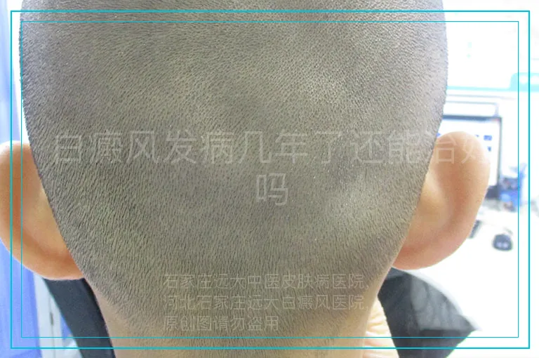 白癜风发病几年了还能治好吗