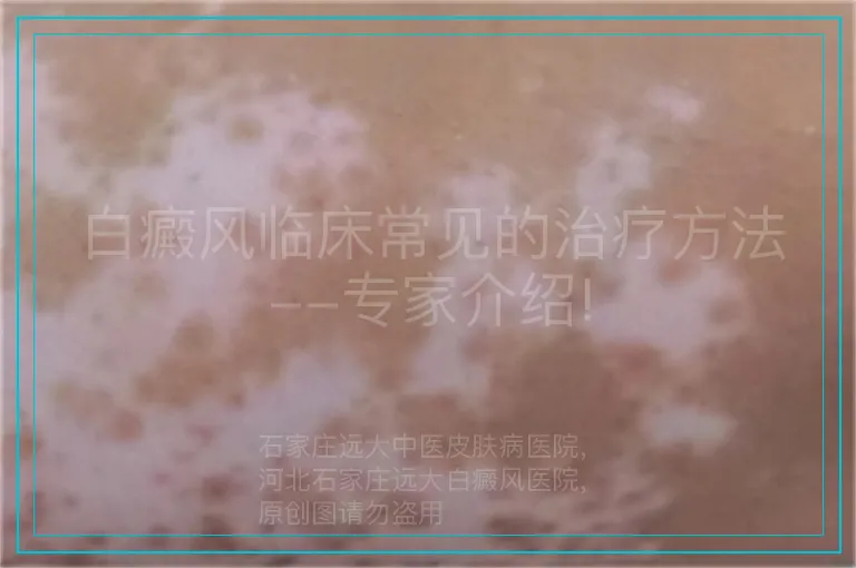 白癜风临床常见的治疗方法--专家介绍!