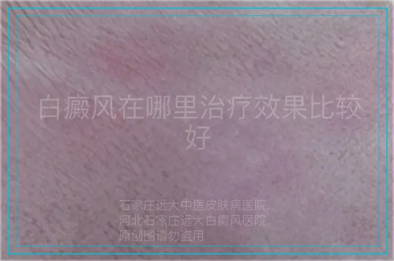 白癜风在哪里治疗效果比较好