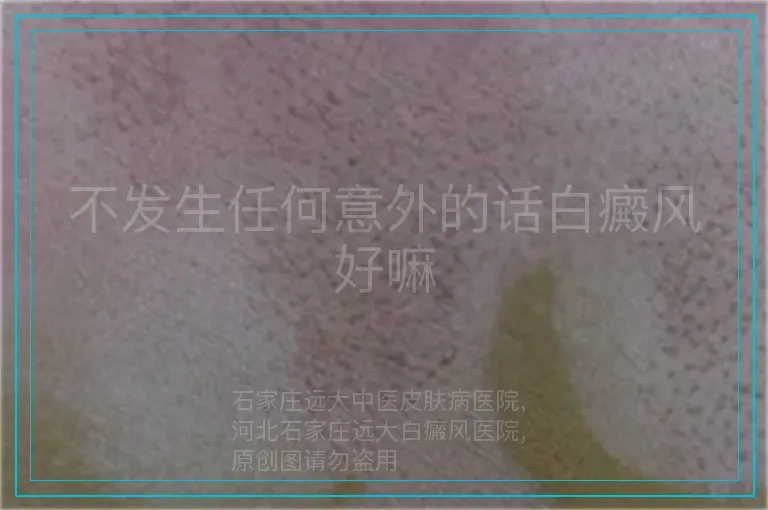 不发生任何意外的话白癜风好嘛