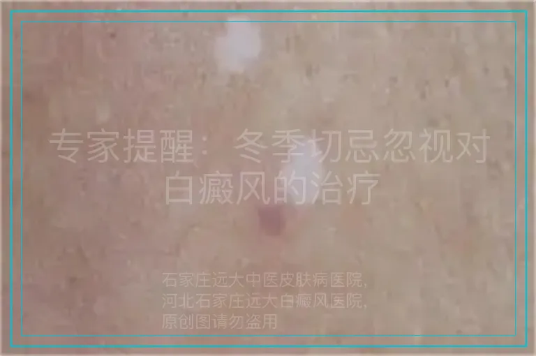 专家提醒：冬季切忌忽视对白癜风的治疗