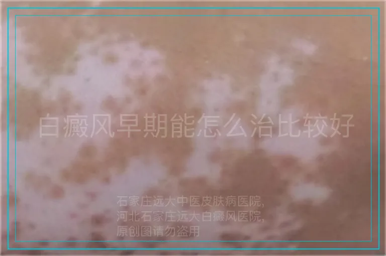 白癜风早期能怎么治比较好