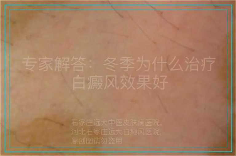 专家解答:冬季为什么治疗白癜风效果好