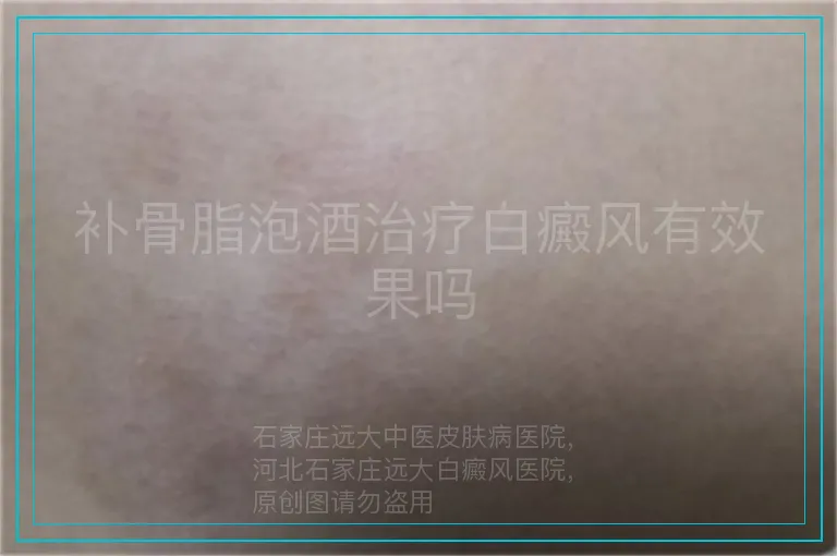 补骨脂泡酒治疗白癜风有效果吗