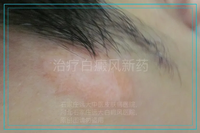 治疗白癜风新药