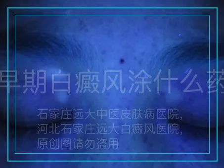 早期白癜风涂什么药