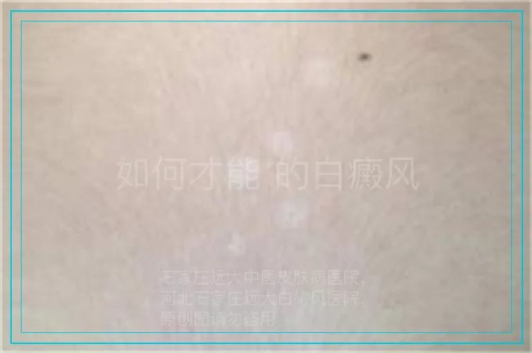 如何才能 的白癜风