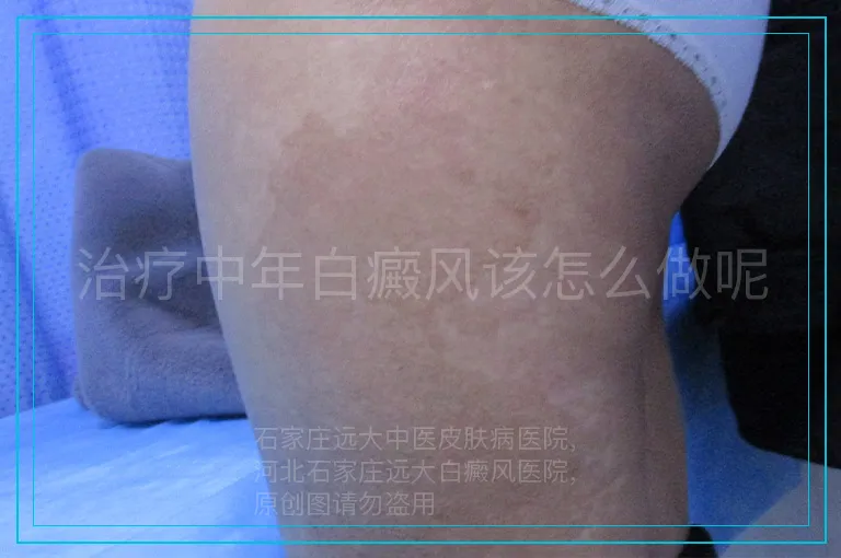 治疗中年白癜风该怎么做呢