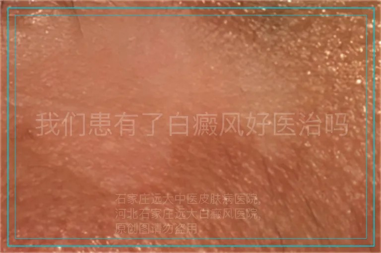 我们患有了白癜风好医治吗
