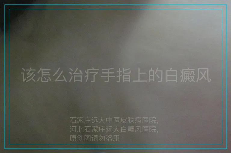 该怎么治疗手指上的白癜风