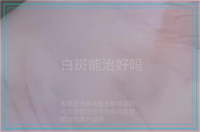 白斑能治好吗