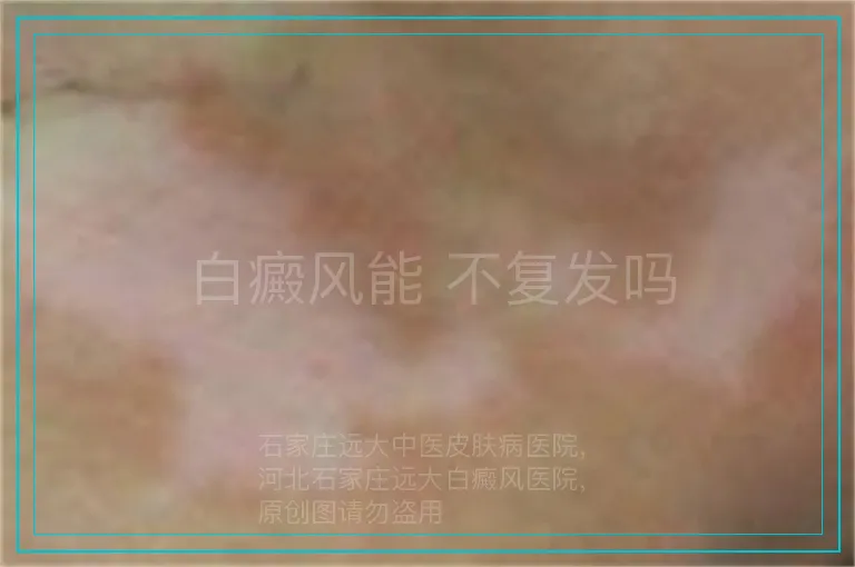 白癜风能 不复发吗