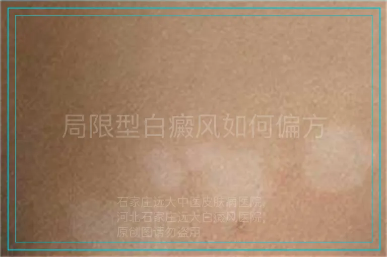 局限型白癜风如何偏方