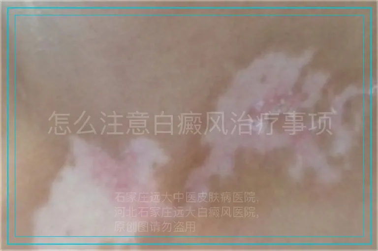 怎么注意白癜风治疗事项