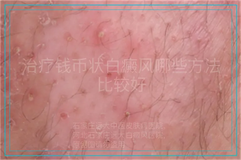 治疗钱币状白癜风哪些方法比较好