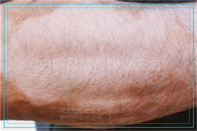 白癜风治疗饮食方法