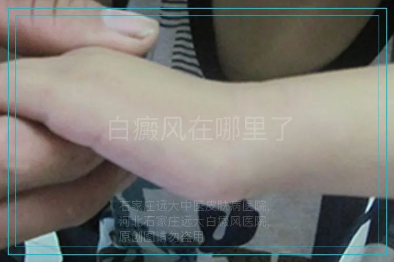 白癜风在哪里了