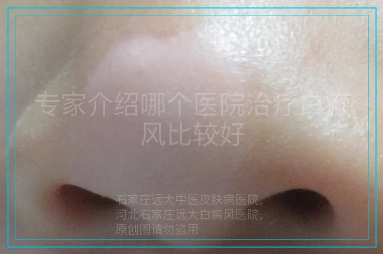 专家介绍哪个医院治疗白癜风比较好