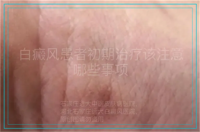 白癜风患者初期治疗该注意哪些事项