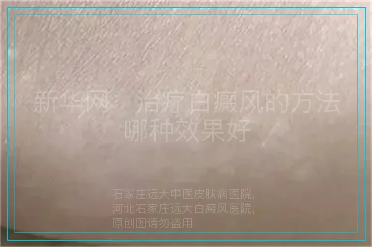 新华网:治疗白癜风的方法哪种效果好