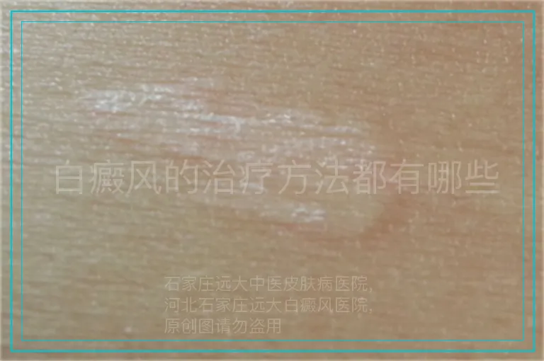 白癜风的治疗方法都有哪些