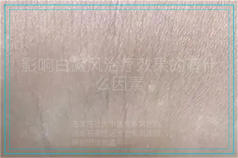 影响白癜风治疗效果的有什么因素