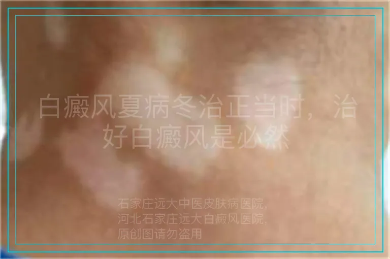 白癜风夏病冬治正当时,治好白癜风是必然