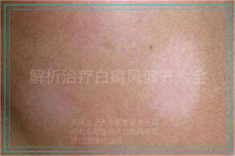 解析治疗白癜风偏方大全