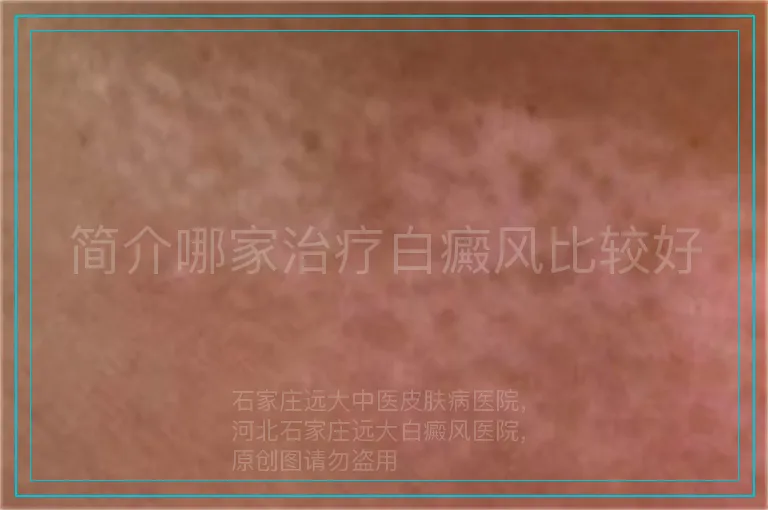 简介哪家治疗白癜风比较好