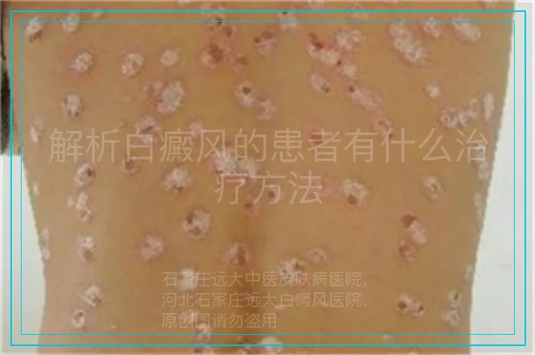 解析白癜风的患者有什么治疗方法