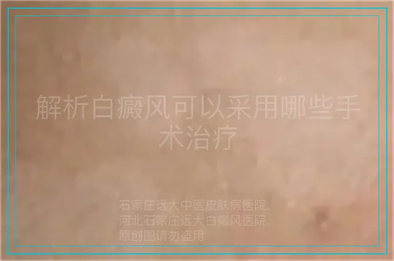 解析白癜风可以采用哪些手术治疗