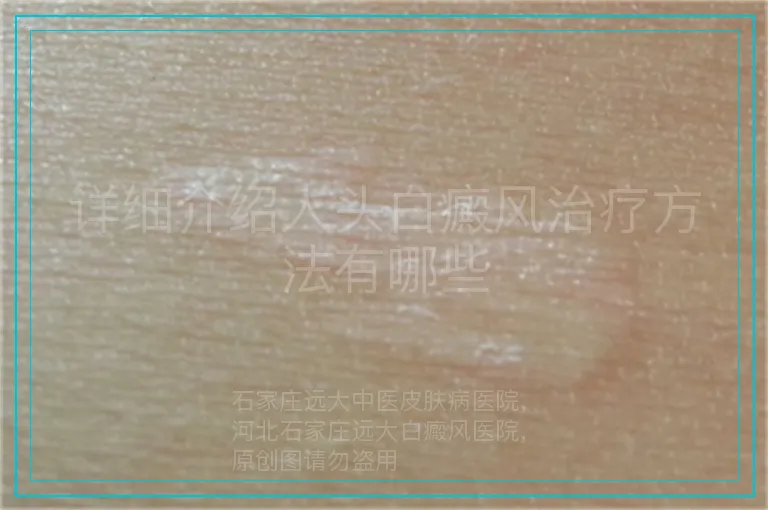 详细介绍人头白癜风治疗方法有哪些