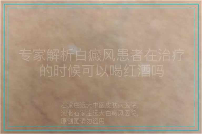 专家解析白癜风患者在治疗的时候可以喝红酒吗