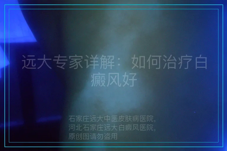 远大专家详解：如何治疗白癜风好