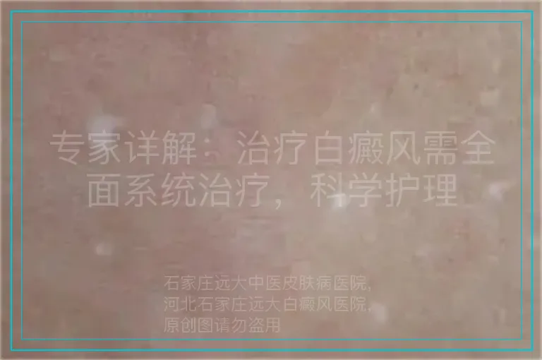 专家详解:治疗白癜风需全面系统治疗,科学护理
